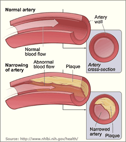 artery with cholesterol